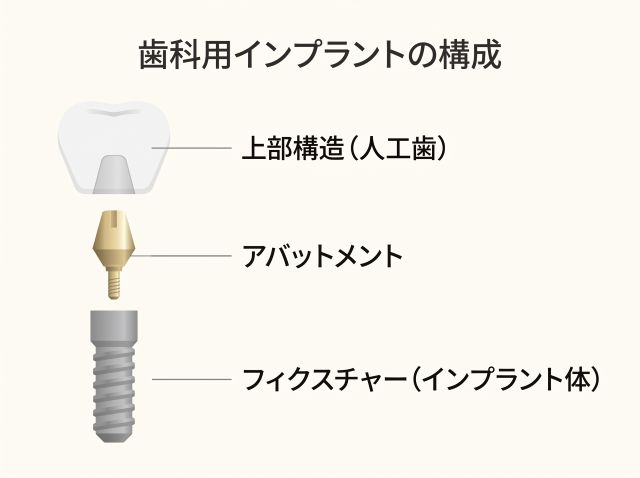 歯科用インプラントの構成（上部構造・アバットメント・フィクスチャー）