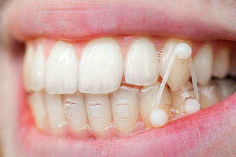 歯の移動メカニズム
