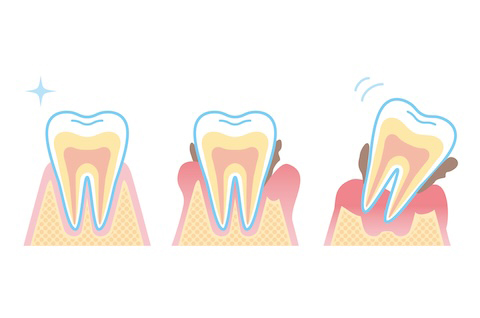 歯周病の進行と症状