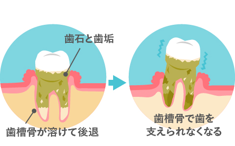  歯周病について