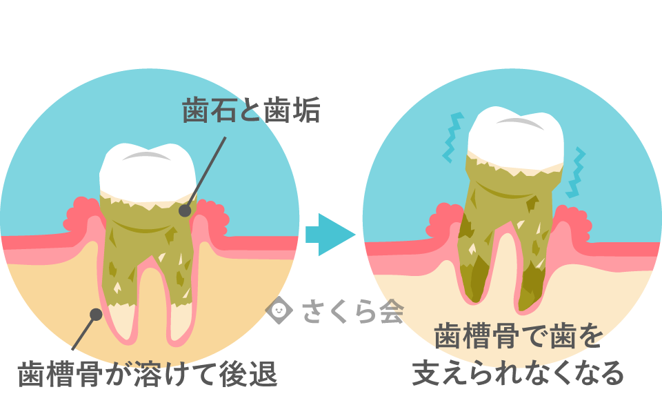 歯周病について