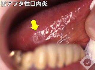 舌アフタ性口内炎