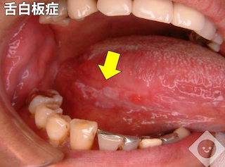 舌白板症