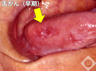 舌がん（早期）
