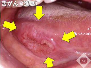 舌がん（進展）