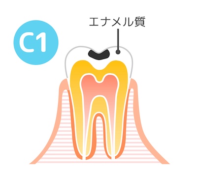 C1の状態の歯の断面図