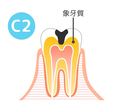 C2の状態の歯の断面図