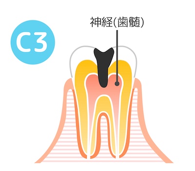 C3の状態の歯の断面図