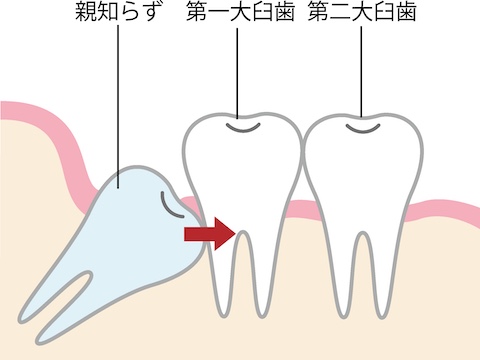 歯の構造図