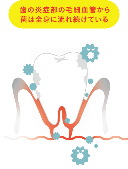 歯の炎症部の毛細血管から歯は全身に流れ続けている