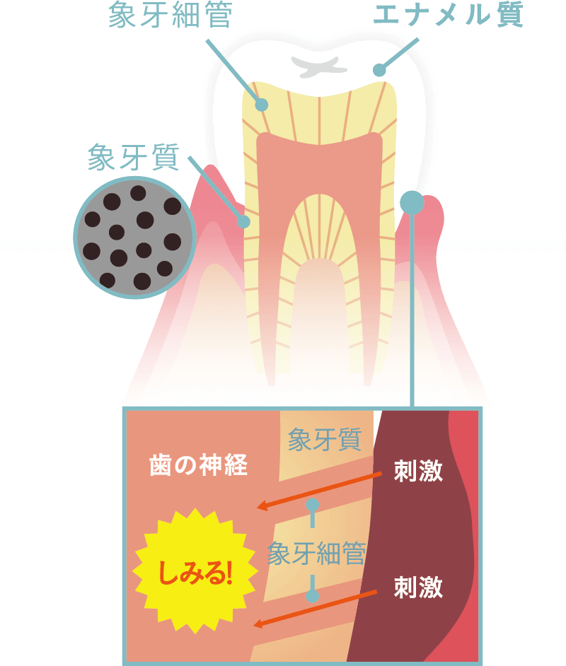 歯と歯ぐきの断面図